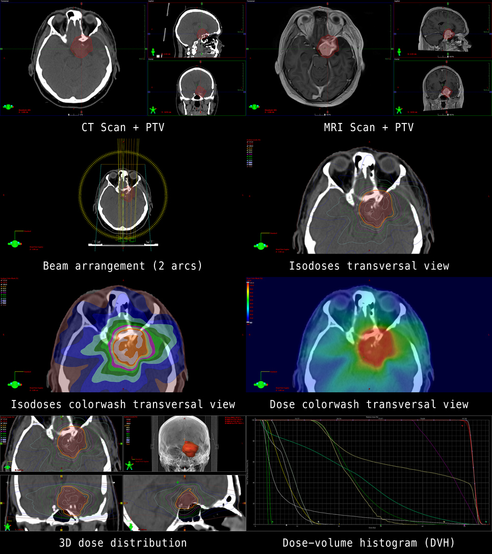The overview of the CT and MRI cross-sections of a middle-aged male patient reveals a relevant residual tumor of a meningioma in the left wing of the sphenoid bone. The partially resected tumor is in the immediate vicinity of the large cerebral vessels and the visual pathway. Furthermore, the result of the calculation for radiation therapy is shown in order to treat the patient in a targeted and gentle way.